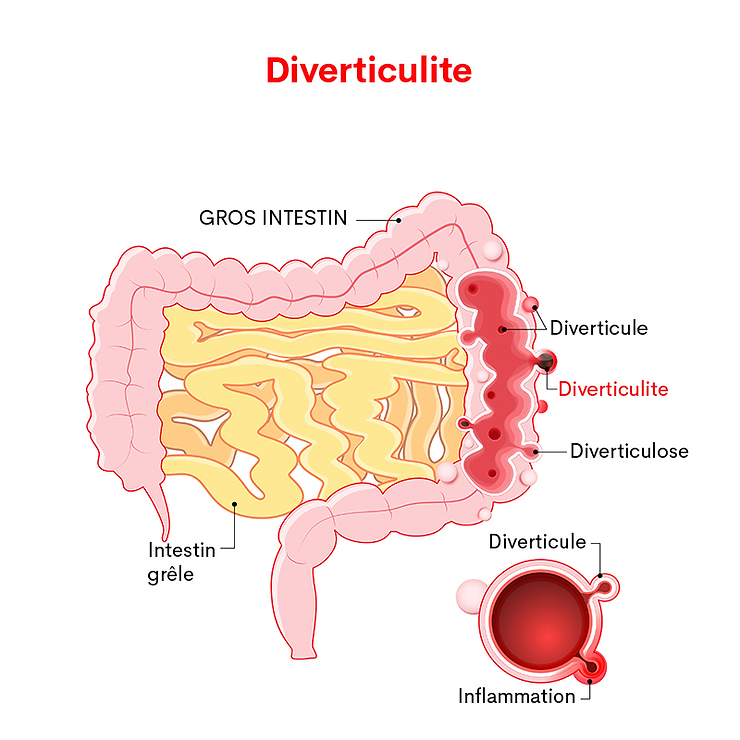 Diverticulites chez les personnes âgées : symptômes, traitements et solutions d’hébergement